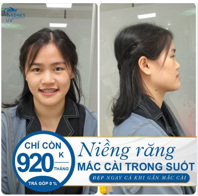 NIỀNG RĂNG CÓ PHẢI NHỔ RĂNG KHÔNG 
