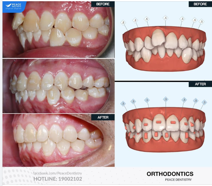 Niềng răng Invisalign cho khách hàng nam 20 tuổi