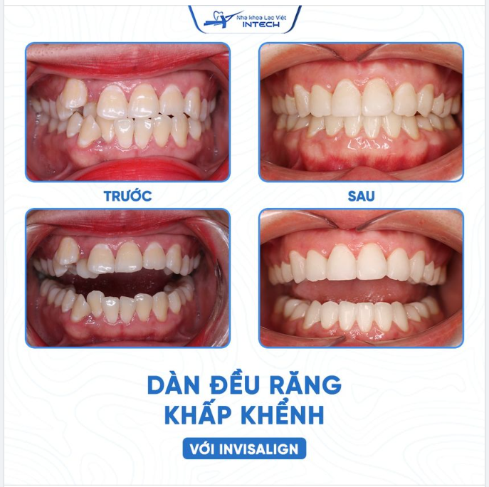 NIỀNG RĂNG KHẤP KHỂNH VỚI INVISALIGN – NHẸ NHÀNG, HIỆU QUẢ