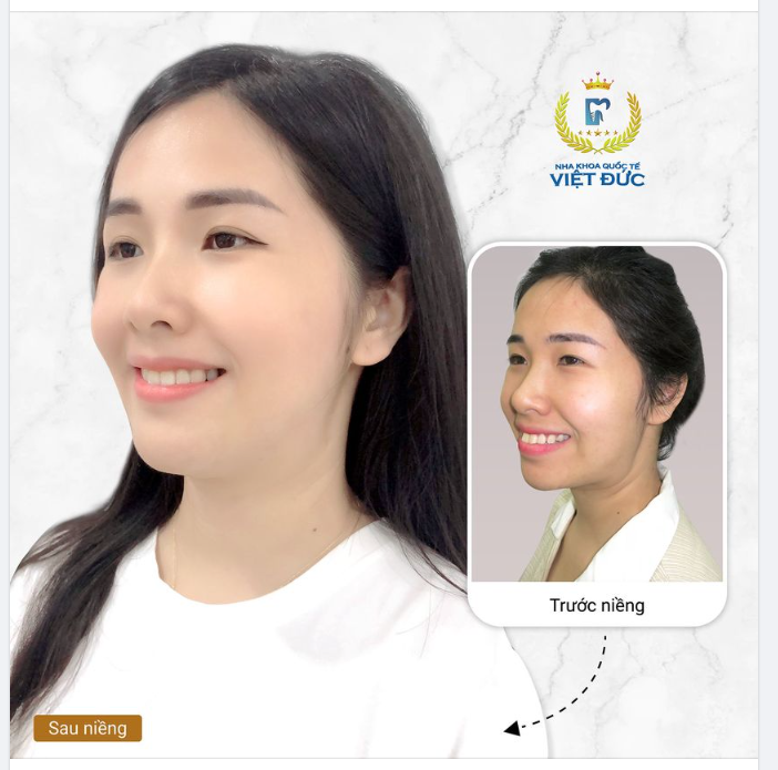 NIỀNG RĂNG, LÃI GÓC NGHIÊNG!