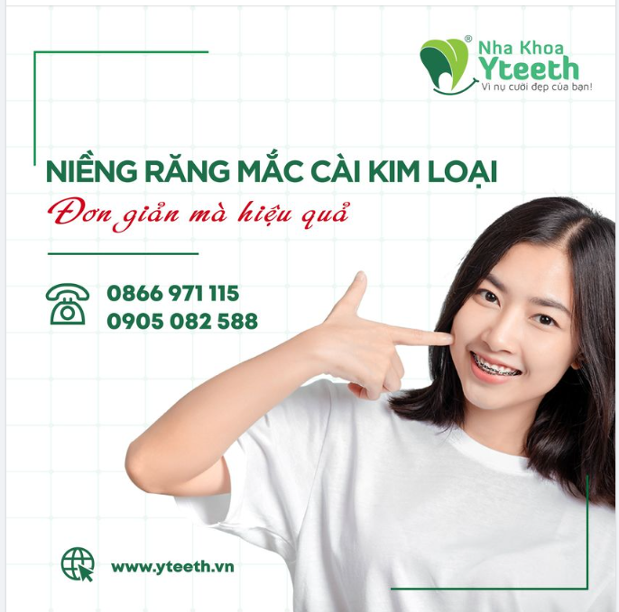 NIỀNG RĂNG MẮC CÀI KIM LOẠI – ĐƠN GIẢN MÀ LẠI ĐẶC BIỆT HIỆU QUẢ