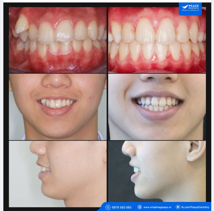NIỀNG RĂNG MẮC CÀI SỨ - THẨM MỸ HƠN VÀ TIẾT KIỆM HƠN