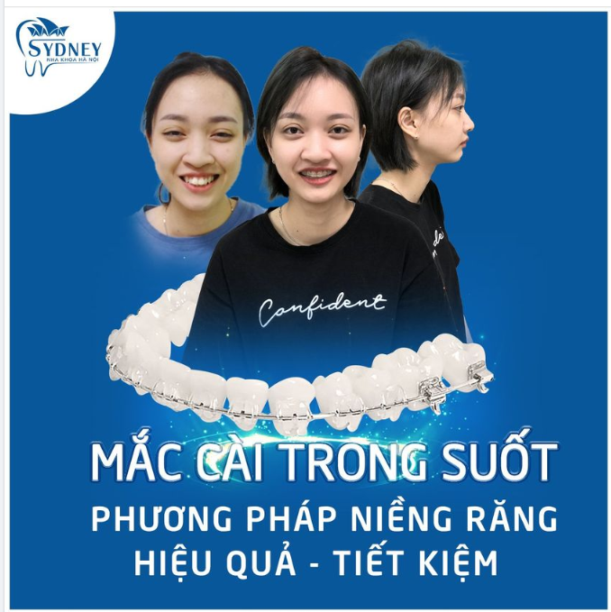 NIỀNG RĂNG MẮC CÀI TRONG SUỐT - NIỀNG RĂNG MÀ VẪN ĐẸP