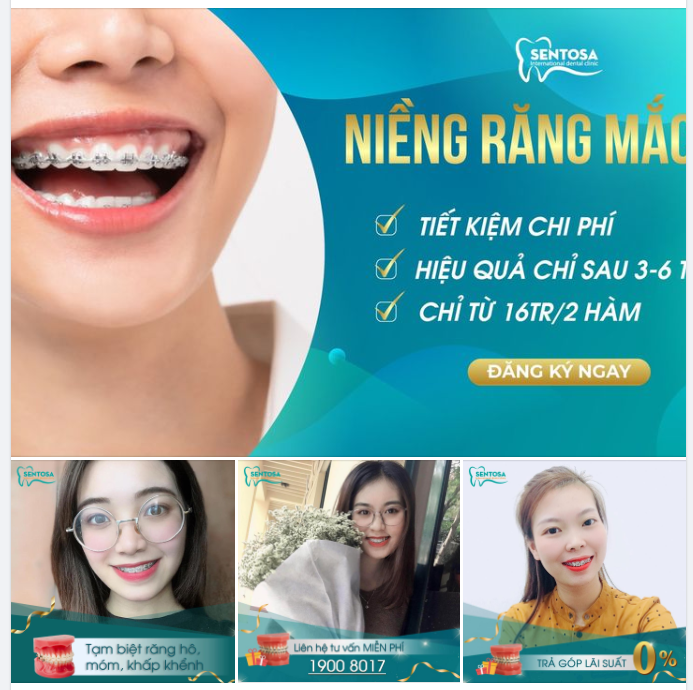NIỀNG RĂNG MẮC CÀI TẠM BIỆT MÓM HÔ THƯA