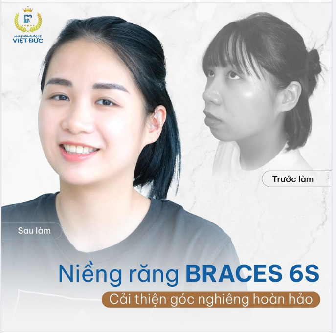 NIỀNG RĂNG - SỞ HỮU GÓC NGHIÊNG HOÀN HẢO