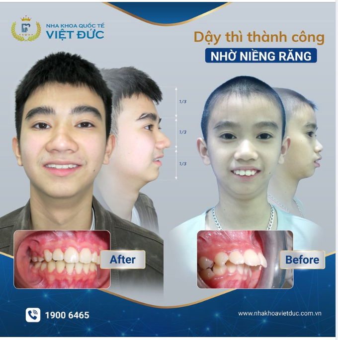 NIỀNG RĂNG SỚM - MÓN QUÀ VÔ GIÁ CHO CON