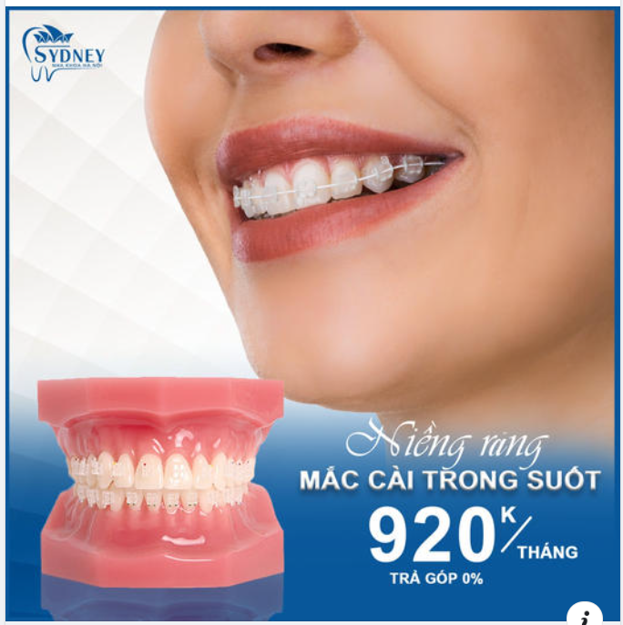 NIỀNG RĂNG TRONG SUỐT 920K/THÁNG