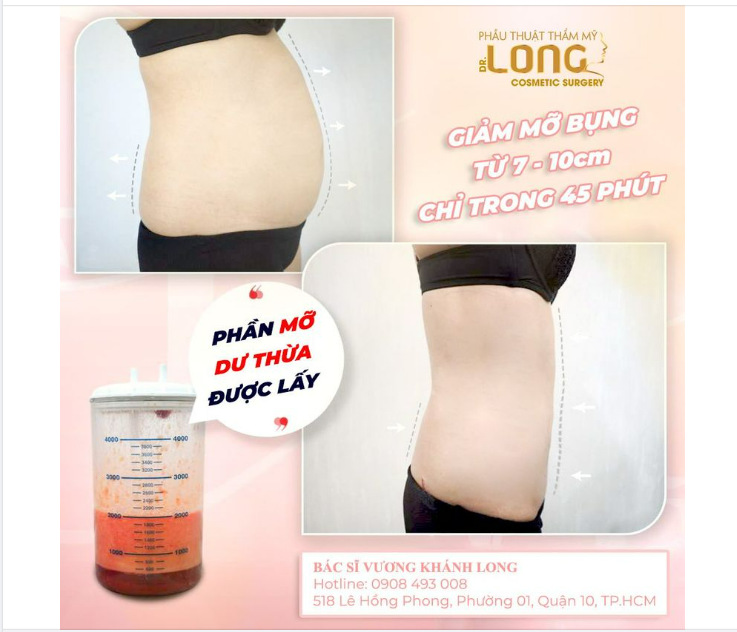 Nỗi ám ảnh bụng xổ sau xinh - Da nhăn, chùng, nhão