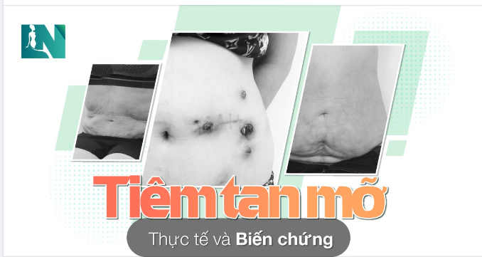 Nói về tiêm tan mỡ bụng, hiện nay tại nước ta, đây là những dạng tinh chất chưa được cấp phép nhập khẩu.