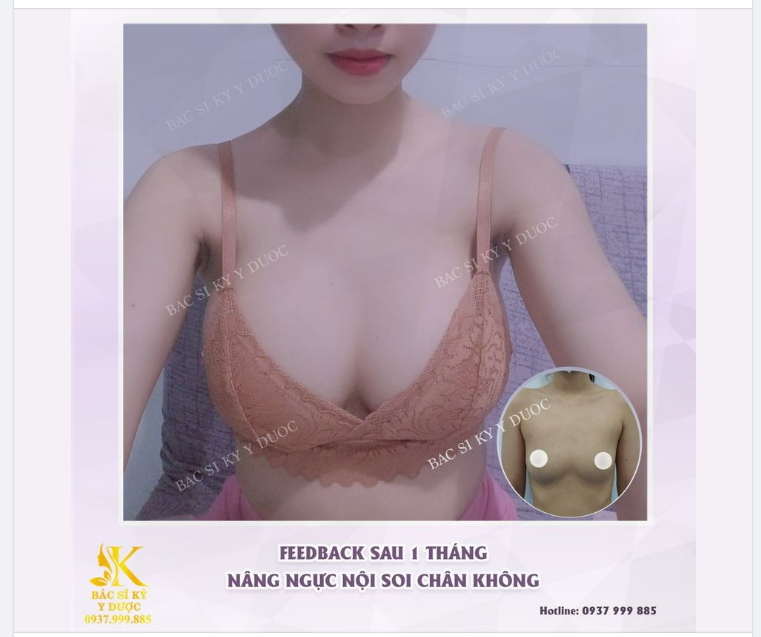 Nóng bỏng với Vòng 1 căng tròn chỉ sau 1 tháng. Kết quả tuyệt vời sau khi Nâng ngực Nội soi Chân không Đường nách.