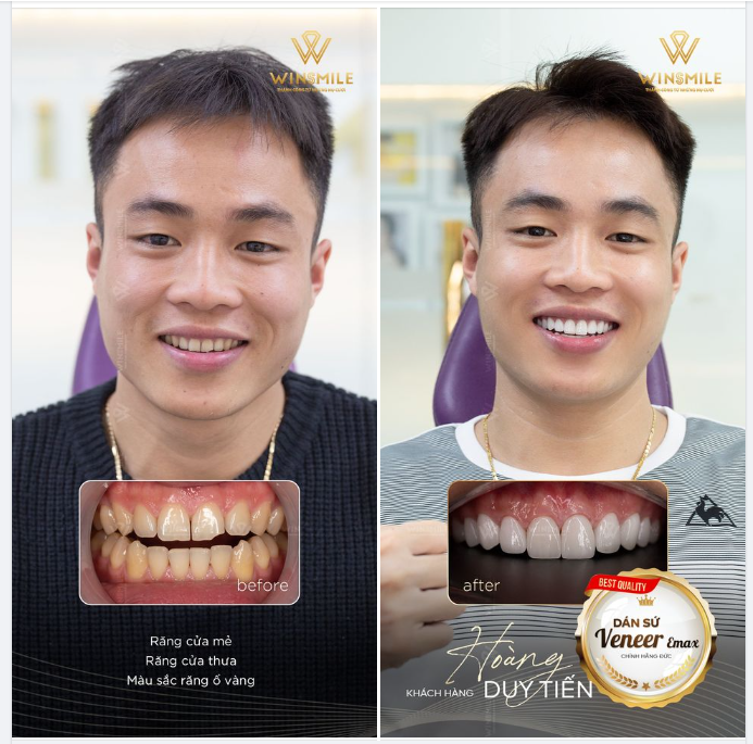 NỤ CƯỜI CHUẨN “SOÁI CA” NHỜ DÁN SỨ VENEER EMAX