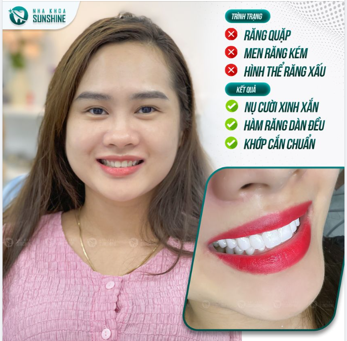 Nụ cười đẹp không chỉ giúp bạn tự tin, dễ tạo thiện cảm cho đối phương, mà nó còn tạo nên cho bạn một gương mặt thần thái và sang trọng.