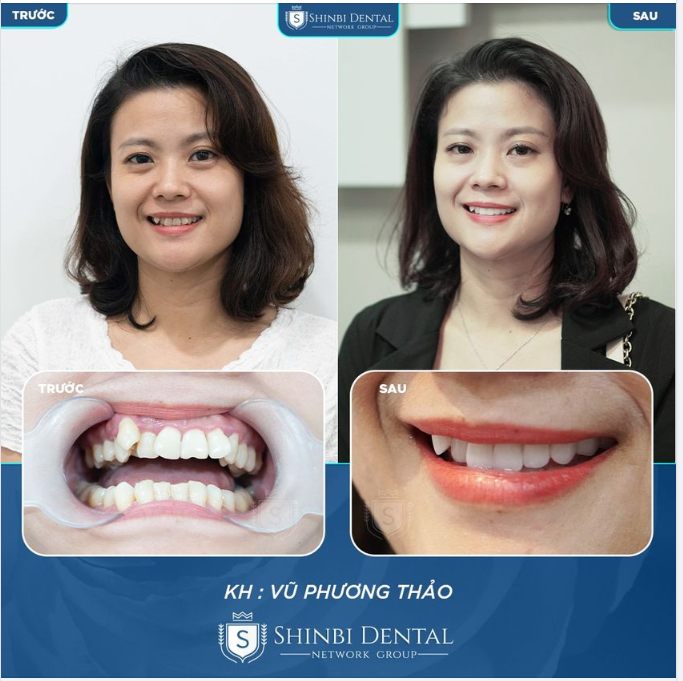 NỤ CƯỜI DUYÊN DÁNG, GIỮ TRỌN NÉT RIÊNG