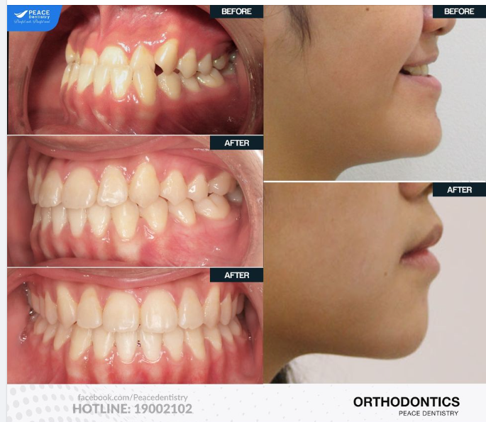NỤ CƯỜI DUYÊN DÁNG VÀ KHUÔN MẶT THANH TÚ SAU KHI NIỀNG RĂNG