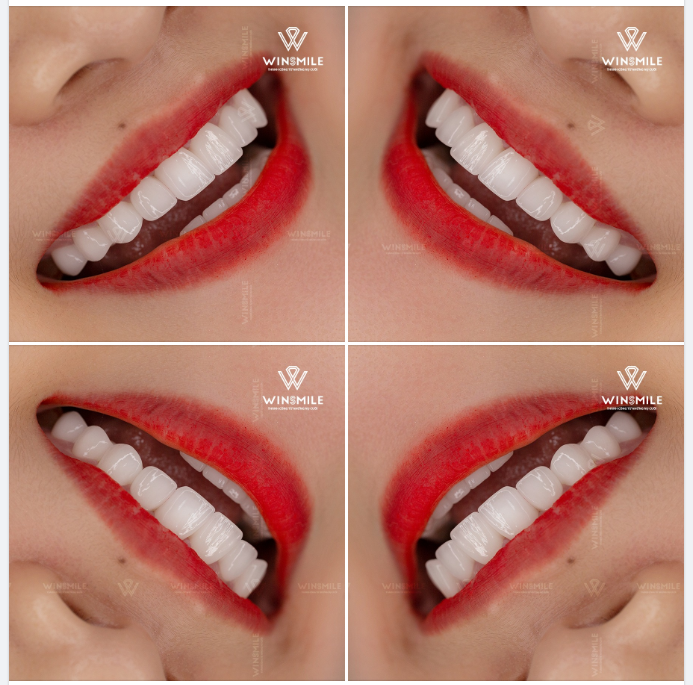 NỤ CƯỜI GÂY THƯƠNG NHỚ NHỜ RĂNG SỨ HT-SMILE