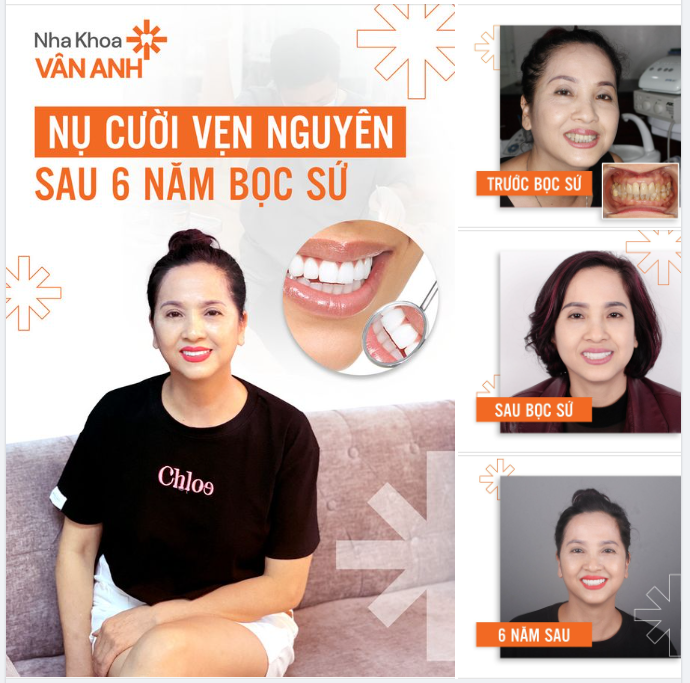 NỤ CƯỜI VẸN NGUYÊN SAU 6 NĂM BỌC SỨ