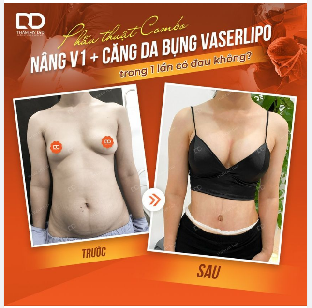 Phẫu thuật COMBO Nâng V1 Harmonic+ Căng da bụng Vaserlipo trong 1 lần CÓ ĐAU KHÔNG