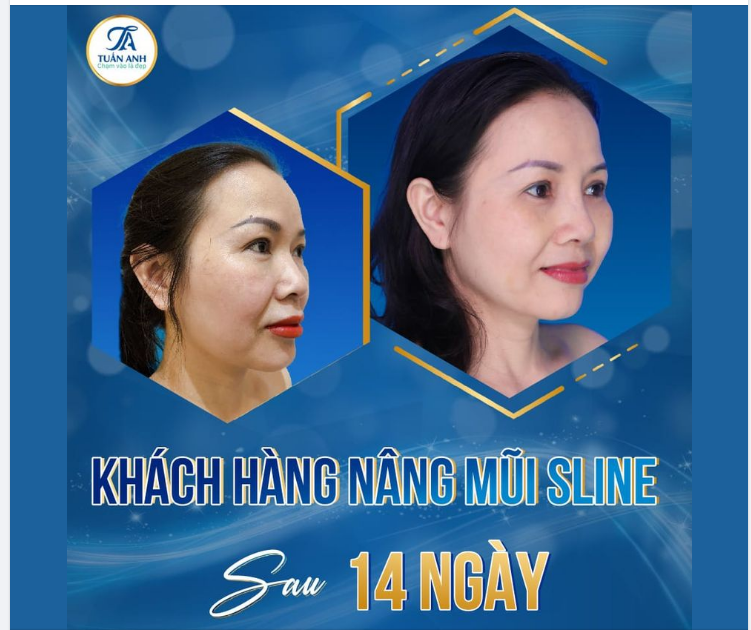 Phụ nữ luôn cần phải đẹp dù ở độ tuổi nào, chị nâng mũi xong ai cũng khen trẻ hẳn ra