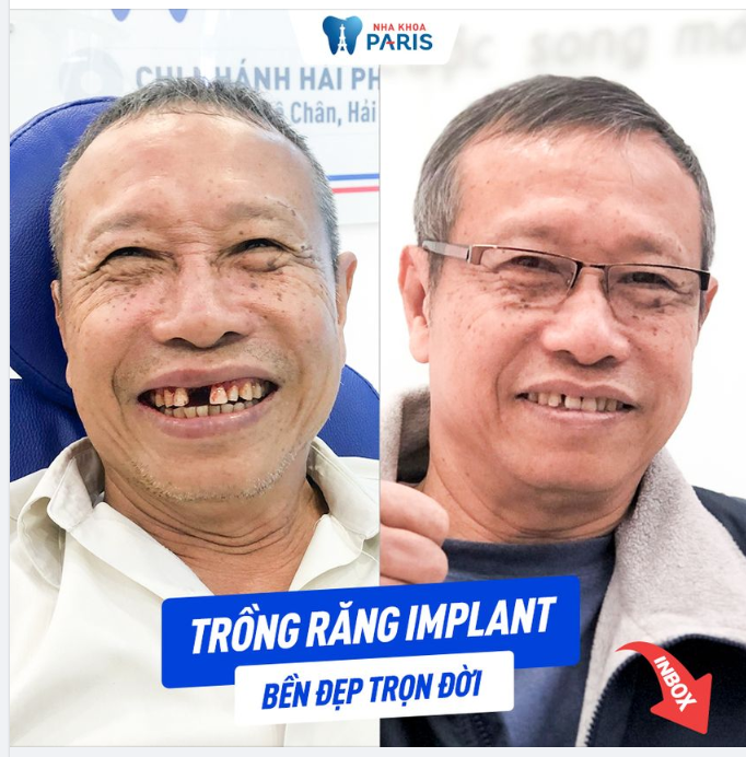 PHỤC HÌNH CẤY GHÉP IMPLANT CHO KH TRẦN VĂN THƯỜNG