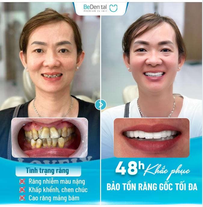 Phục hình thẩm mỹ case răng nhiễm màu, khấp khểnh