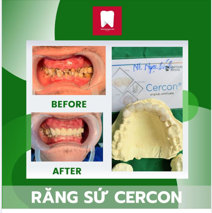 PHỤC HÌNH THẨM MỸ RĂNG SỨ CERCON