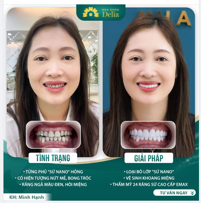 Phục hồi sứ hỏng - Tìm lại nụ cười khoẻ đẹp
