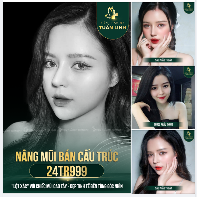 PHƯƠNG PHÁP NÂNG MŨI BÁN CẤU TRÚC