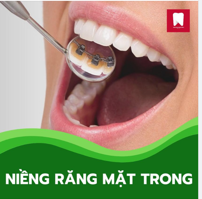 Phương pháp niềng răng mắc cài mặt trong