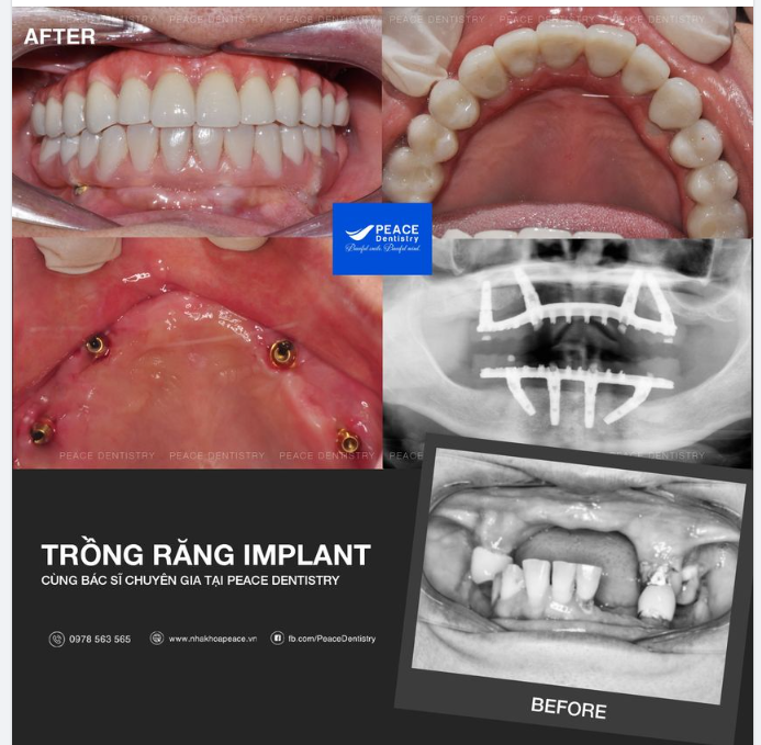 Q&A -  TRỒNG RĂNG IMPLANT
