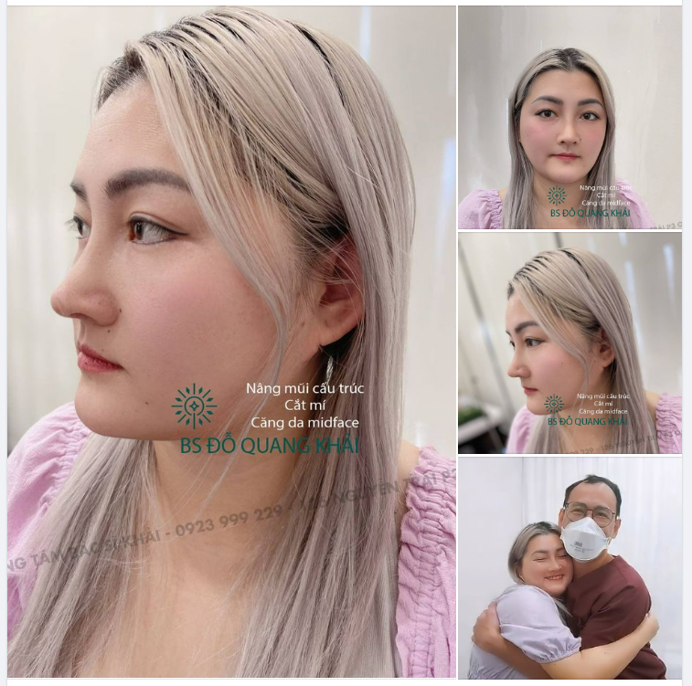 QUÁ HẠNH PHÚC VỚI KẾT QUẢ PHẪU THUẬT CHỊ KHÁCH HÀNG VUI MỪNG KHI GẶP LẠI BÁC SĨ KHẢI
