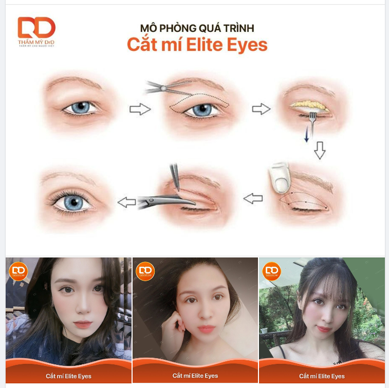 QUY TRÌNH CẮT MÍ ELITE EYES ĐƯỢC THỰC HIỆN NHƯ THẾ NÀO