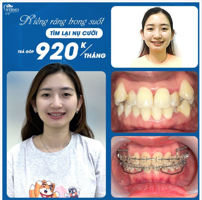 RĂNG BỊ HÔ HÀM TRÊN CÓ NIỀNG ĐƯỢC KHÔNG 