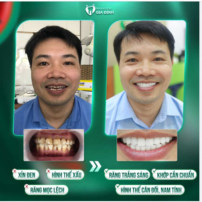RĂNG ĐẸP KHÔNG KHÓ, CHỈ CẦN ĐẾN NHA KHOA GIA ĐÌNH