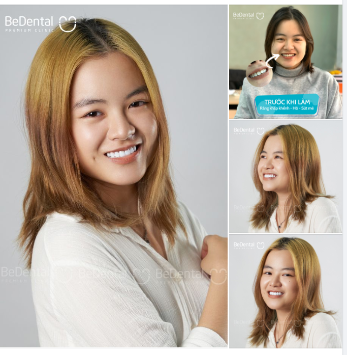 Răng hô, sứt mẻ, khấp khểnh - Cô gái quyết thay đổi để tìm lại tự tin