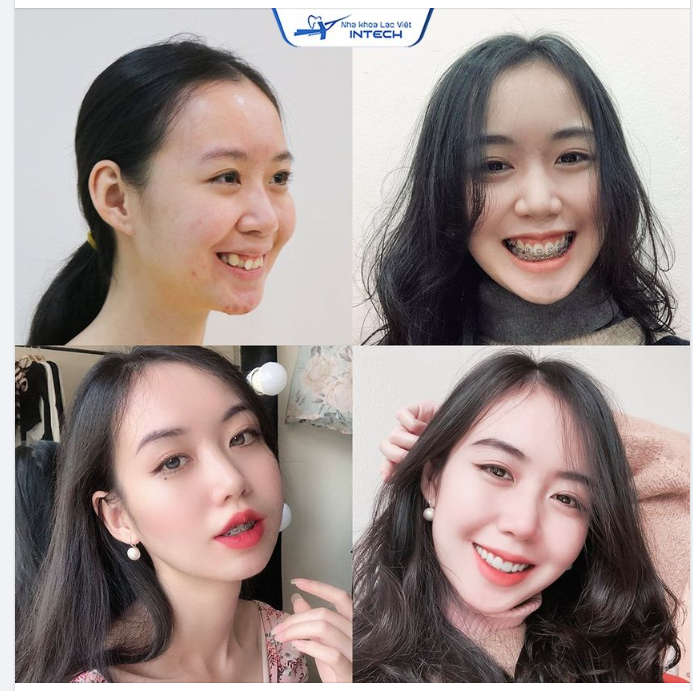 RĂNG KHẤP KHỂNH, CƯỜI HỞ LỢI THAY ĐỔI THẾ NÀO
