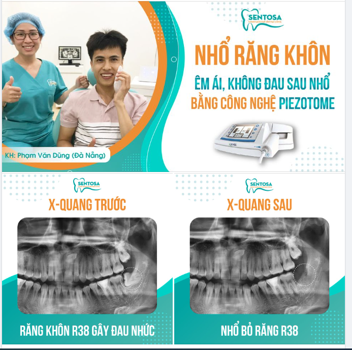 RĂNG KHÔN MỌC DẠI - PHẢI XỬ LÝ NGAY!