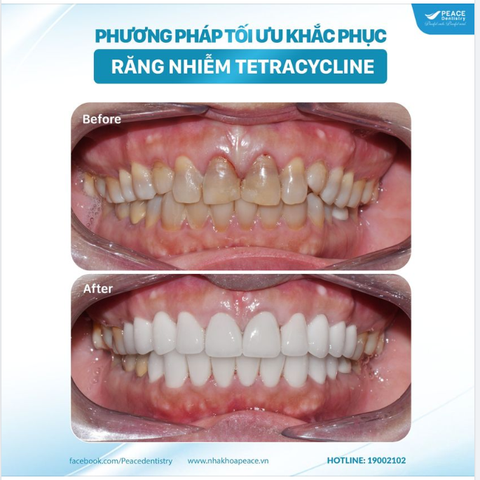 RĂNG NHIỄM TETRACYCLINE VÀ GIẢI PHÁP BỌC RĂNG SỨ THẨM MỸ