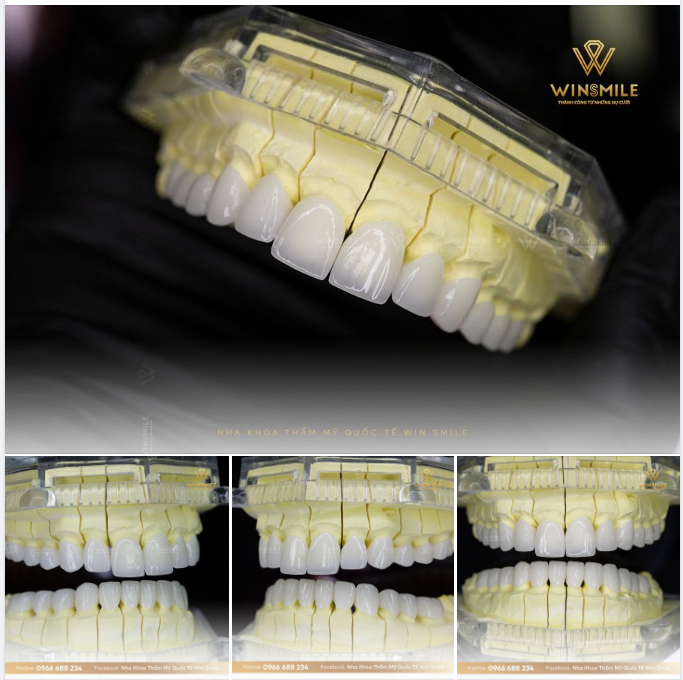 RĂNG SỨ CERAMILL - CHẤT LƯỢNG CHUẨN ĐỨC - ĐIỂM 10 HOÀN MỸ