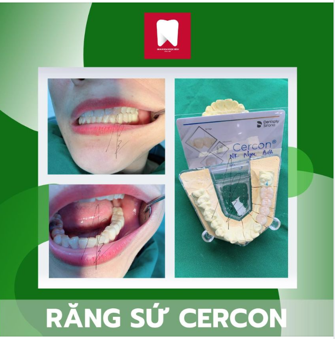 RĂNG SỨ CERCON - SỰ LỰA CHỌN LÝ TƯỞNG TRONG THẨM MỸ RĂNG SỨ