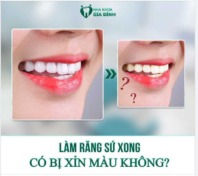 RĂNG SỨ CÓ BỊ XỈN MÀU KHÔNG?