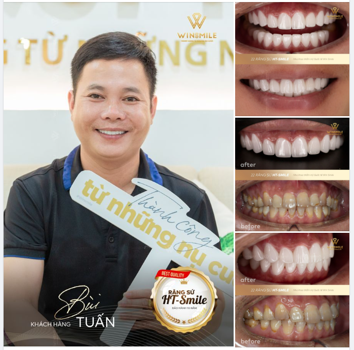 RĂNG SỨ HT-SMILE – SIÊU PHẨM “ĐÁNH THỨC” NỤ CƯỜI NGỦ QUÊN
