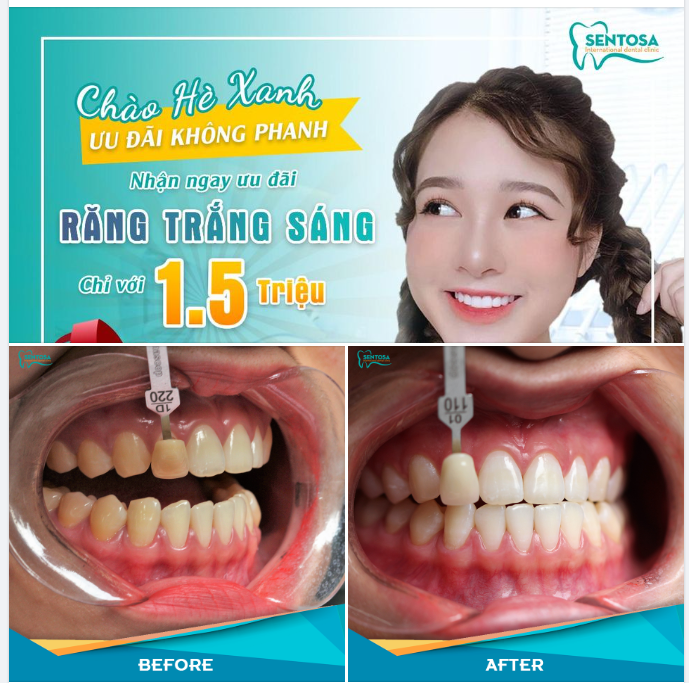 RĂNG TRẮNG SÁNG CHỈ TRONG 45 PHÚT