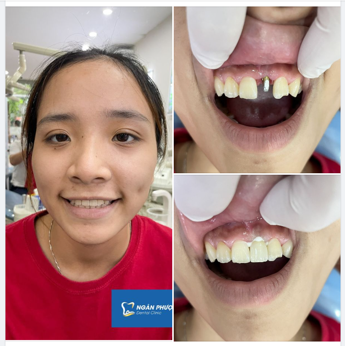 Răng vùng thẩm mỹ mất tiêu - Phục hình răng mới đẹp xinh tức thì