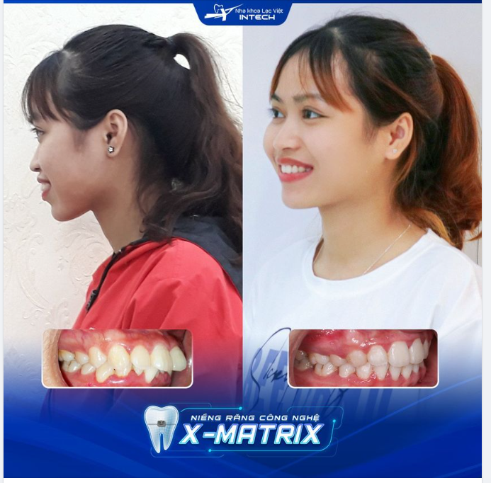 RĂNG XẤU KHÔNG DÁM CƯỜI, CHỈ CÓ KHỔ CHỦ MỚI HIỂU