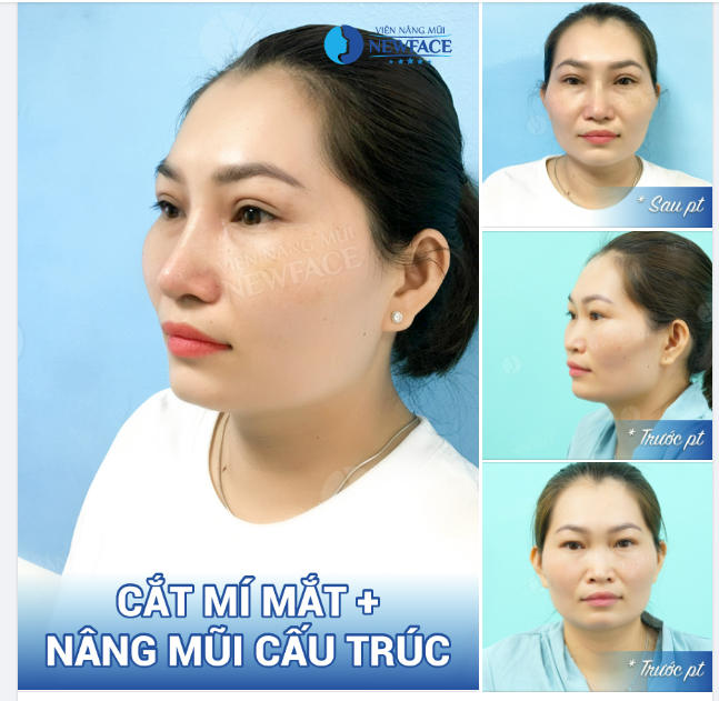 “SANG XỊN MỊN” HƠN NHỜ COMBO MŨI CẤU TRÚC + TẠO 2 MÍ