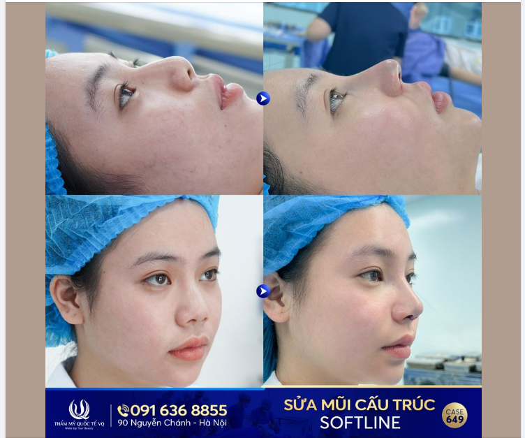 Sau 2 lần tiêm filler và tiêm tan filler tại Spa không uy tín, mũi của bạn K.H ở Tp HCM đã gặp 1 số biến chứng