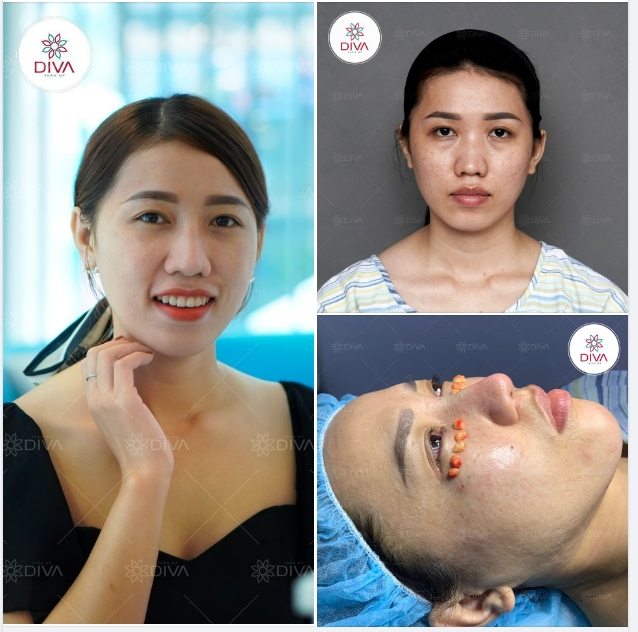SAU 3 TUẦN NÂNG MŨI, CẤY MỠ, LẤY MỠ MÍ DƯỚI MINH THƯ ĐẸP TỰ NHIÊN HÀI HÒA