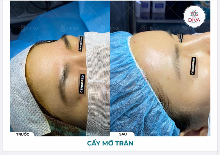 SAU CẤY MỠ TRÁN CÓ ĐẸP LIỀN KHÔNG