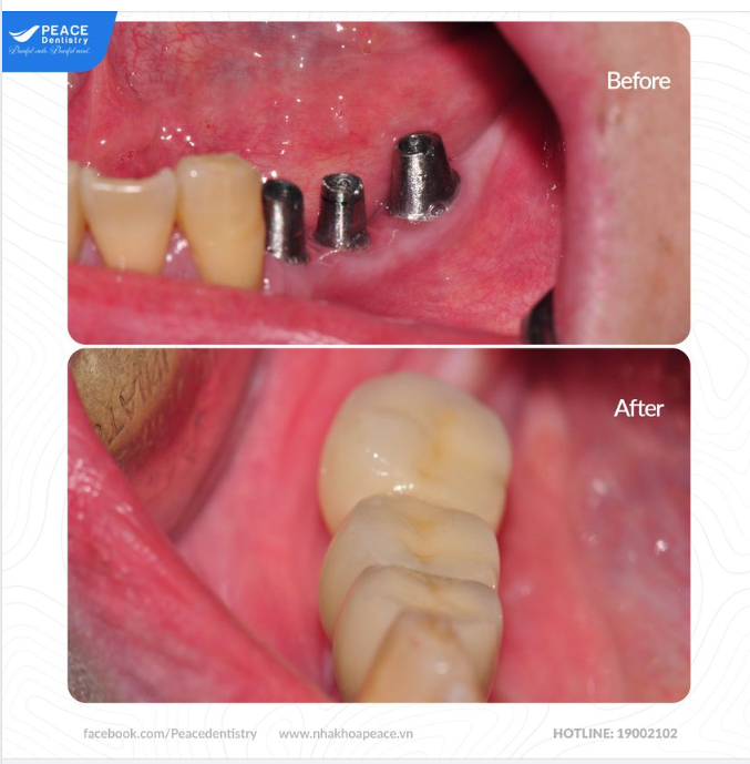 Sau khi cấy trụ Implant và phục hình răng sứ để thấy vì sao  trồng răng Implant được xem là phương pháp trồng răng giả cố định tốt nhất!