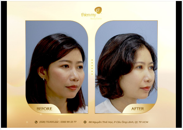 Sở hữu đôi mắt 2 mí bền lâu với Dịch vụ Nhấn mí đa điểm tại Thiện Mỹ